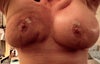 after dbl mastectomy & 650 saline implants