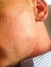 Right side--ice pick , Rolling scars