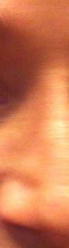 under eye area when smiling