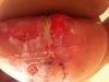 R breast incision splitting above the T zone. picture approximately 4 weeks post surgery