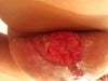 Left breast incision split above the T zone, my PS says "its normal as long as it is the red beefy color, new skin will form over" picture approximately 4 weeks post surgery