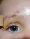 Scar through right eyebrow 21 month old