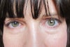 Ptosis surgery right eye (on left in photo)