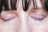 Ptosis surgery right eye (on left in photo)