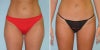 Normal hips