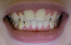 Truthfully on a real smile, its not all that bad from far, but if you see my teeth from the side an overbite shows.