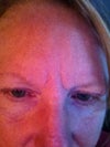 Day 8 after touch-up
