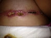 6 Weeks post op Full TT. Infected? Healing okay?