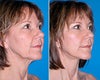 Mini Lift Before and After Photos