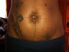standing (ugly stretch marks but improved 100% with chemical peel)