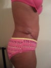 PO 15 Days The dog ear that my PS tried to avoid but said he didn't want to chase it around my back. You can also see the swelling on my flanks. Ive developed a seroma above my belly button.