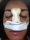 Day after my surgery