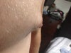 Right nipple
