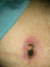 Right nipple