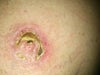 Left nipple