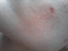 left cheek. redness is extra noticeable.