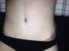 This photo is 6 weeks after tummy tuck.