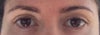 eyes after