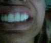 front tooth