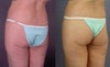 Butt lift before & after photos