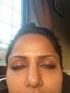 Aftery Surgery - Today