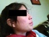 2 years after surgery
