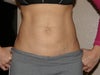 My Stomach frontal view