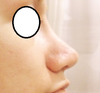 post op 11 months