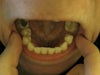 If you look to the Right (which is my left) There's the missing tooth where the tooth next to it as fallen in the hole. The tooth on the opposite site which had the baby tooth on it has grown inward because the dentist did not remove it at all, causing me to pull it out myself but it was too late to fix the inward tooth.