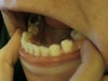 You can see how the tooth is missing & the one next to it has slid down in its place.