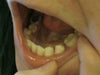Better view of the hole which the tooth is no longer there & the tooth next to it has fallen in.