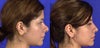 this woman had an augmentation and in the next picture you see how te eyes changed to become more beautiful from front.