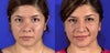 I had my nose bridge taken down too much and I experienced exactly the oposite outcome, my eyes went from beautiful to very weird...