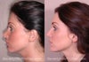 here is another example where the eyes went from weird looking to more normal after an augmentation.
