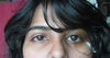 doesnt my surgery eye looks bigger than the normal one