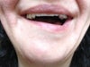 Crooked smile two weeks post-op