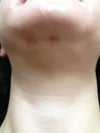 Chin & Neck two weeks post-op