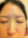 Right has about 2 mn or 3 mm of scleral show and left has 1-2 mm