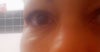 Righ eye