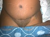 Full view of scar