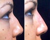 Non Surgical Nose Job Before and After Photos