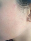 Uneven discoloration