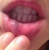 Venous Malformation - Inner Lip