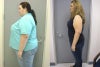 Lap Band Before and After Photos