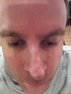 18 months post operation.