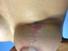 Another pic of stretched out scar