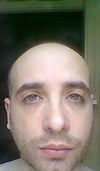 Before Surgery Pic 1 (2012)