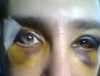 After Surgery (2013)