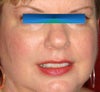 Age Spots, Broken Capillaries, Minor Wrinkles and Acne Scars
