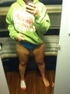 Fatty thighs and Cellulite